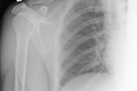 xray of shoulder, ribs, and lunbs